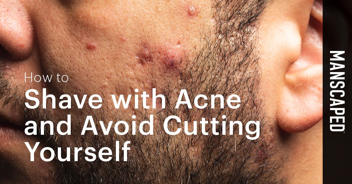 How to shave with acne and avoid cutting yourself