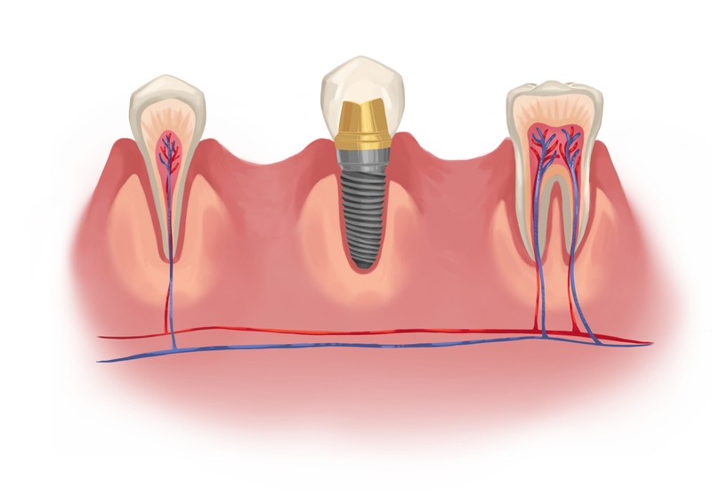Single dental implant next to natural dentition