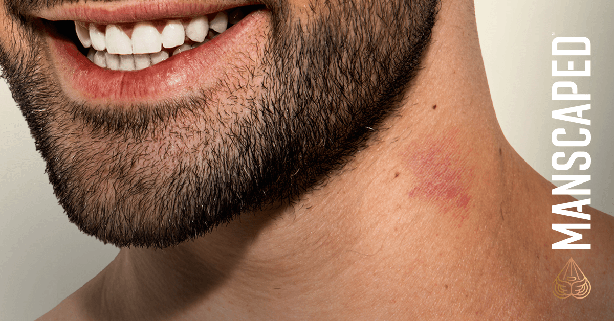 How to get rid of hickeys. MANSCAPED™ Blog