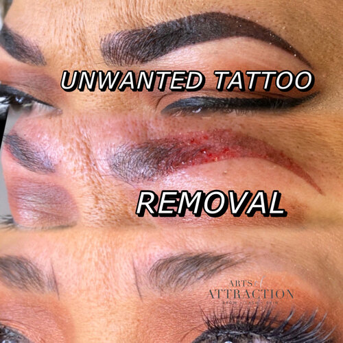 Tattoo Removal Training