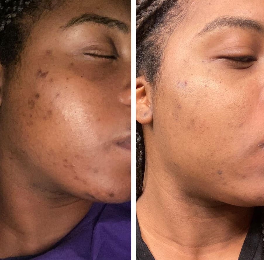 AfterGlow Peel Before & After Treatment