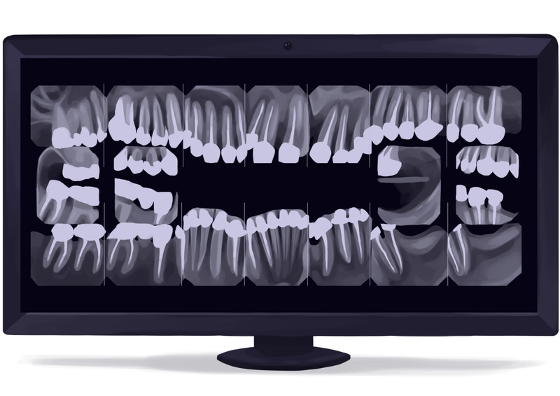 Full moth FMX dental x-rays digital