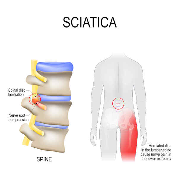 Does CBD Oil Help Sciatica?