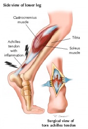 "Plantar