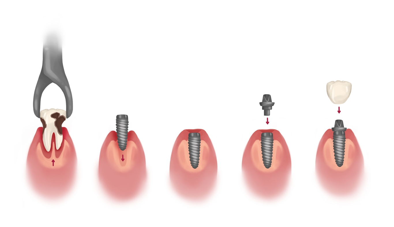 Do dental implants hurt? Tooth implants pain facts and tips