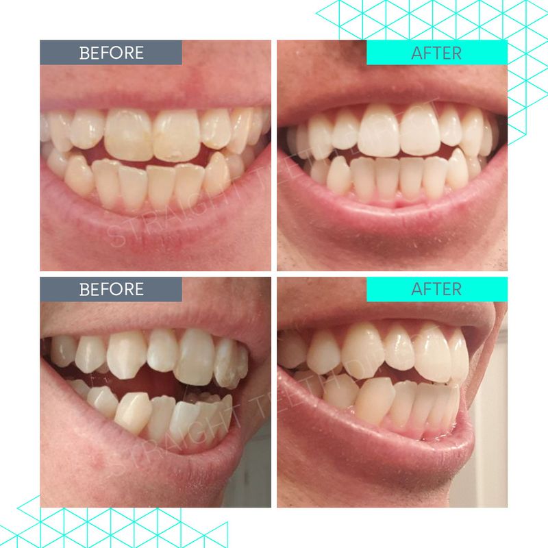 Straight Teeth Direct Pricing Aligner cost made simple