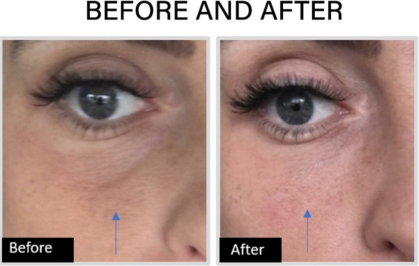 before & after Skin Rejuvenation