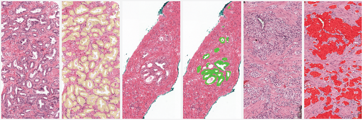 Example segmentation generated by the deep learning system: benign tissue (green), Gleason 3 (yellow), Gleason 5 (red).