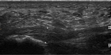 "Plantar