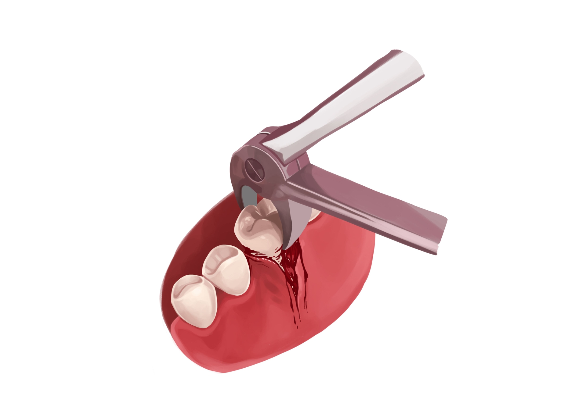 Tooth extraction costs from $50 up to $1,100