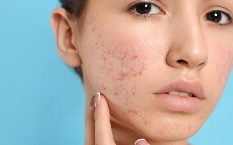 Acne and Rosacea: Know the Difference