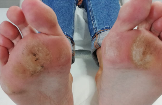 imperial feet corns and calluses