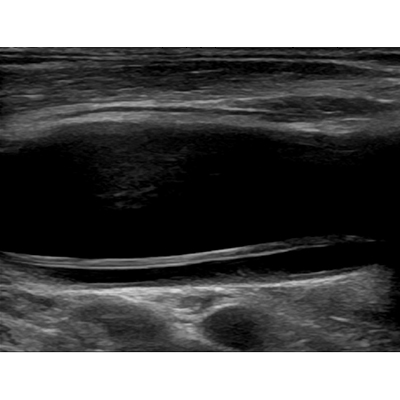 A common carotid artery dissection ultrasound