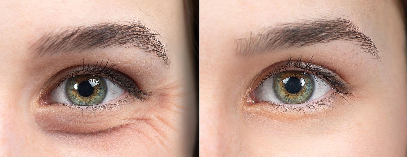 eye wrinkle before after