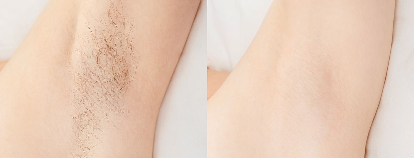 brazilian-laser-hair-removal before after