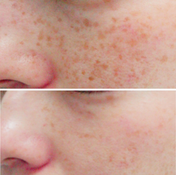 before-after-skin-treatments-6