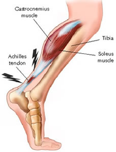 "Plantar