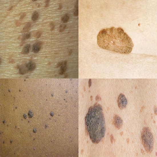 Skin Tag, Milia, Red Dot & Growth Removal - Safe, Non-invasive Treatments