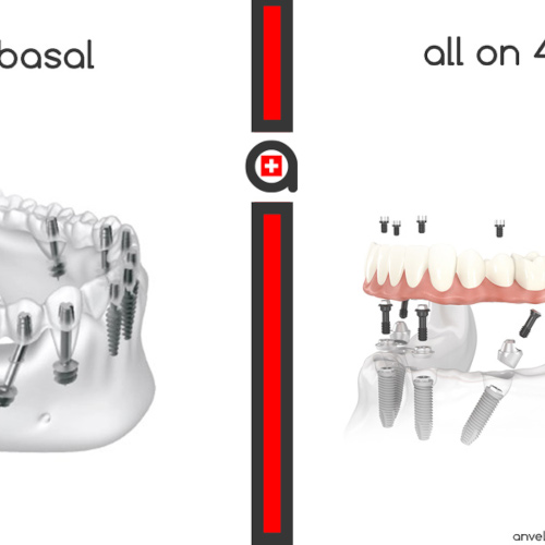 Implant basal vs all on 4