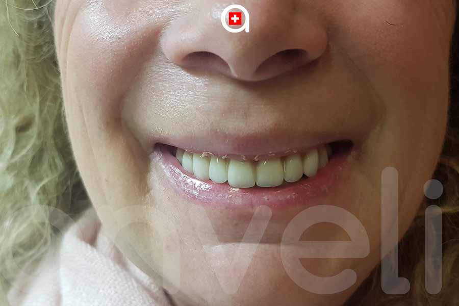 Témoignage soins dentaires anveli suisse