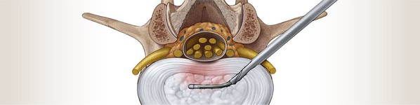 Tratament hernie de disc | Centrele Ares | Neuroradiologie interventionala