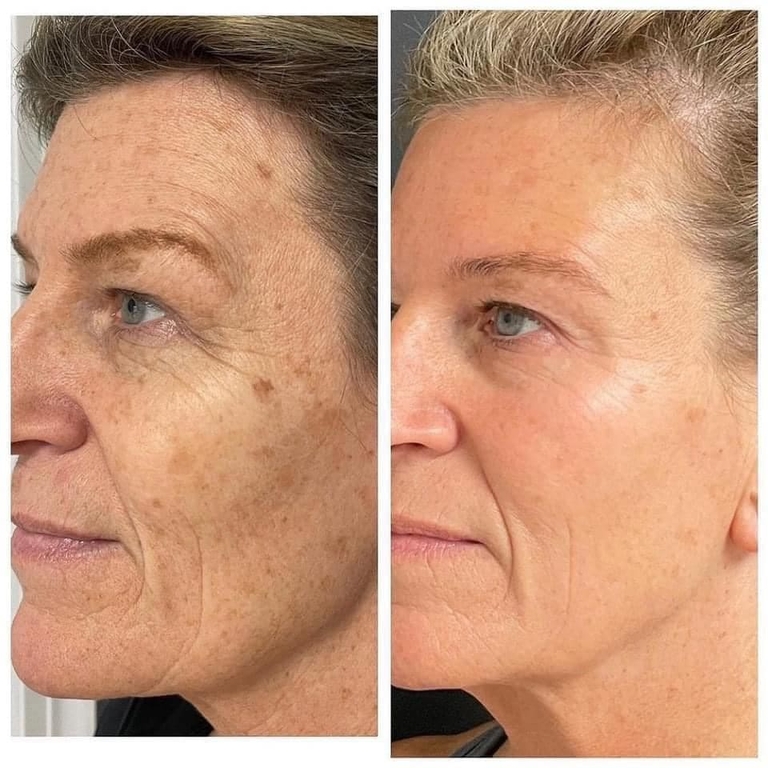Microneedling Ottawa Treat Sun Damaged Skin, Acne, Scarring