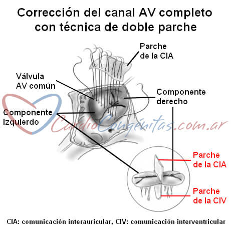 Cirugia-canal-compl