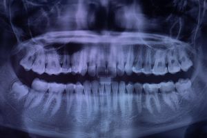 A x-ray taken by Glenbrook Dental staff showing the soon-to-erupt wisdom teeth of a patient