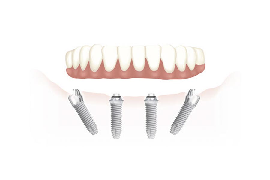 Studio Dentistico Riccardi Lodi - Chirurgia guidata