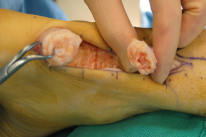 "Plantar