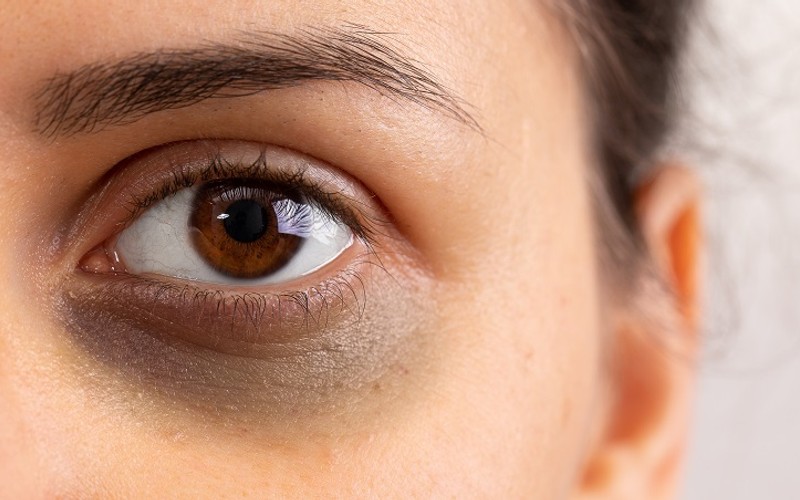 How to Get Rid of Dark Circles and Under Eye Bags