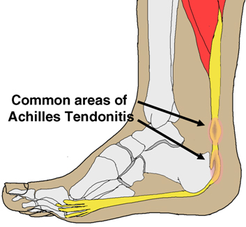 "Plantar