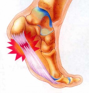 "Plantar