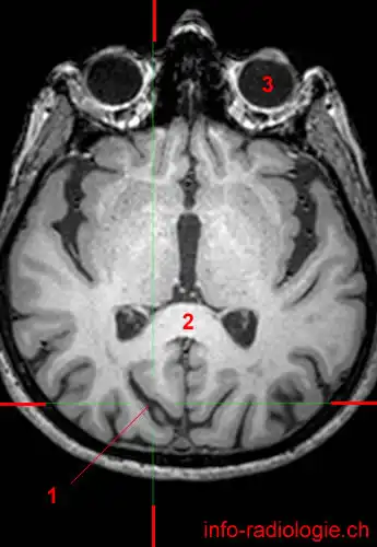 Parietooccipital sulcus (MRI) - W-Radiology