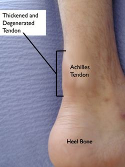 "Plantar
