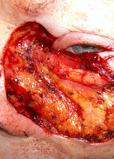 mohs-face-before.jpg