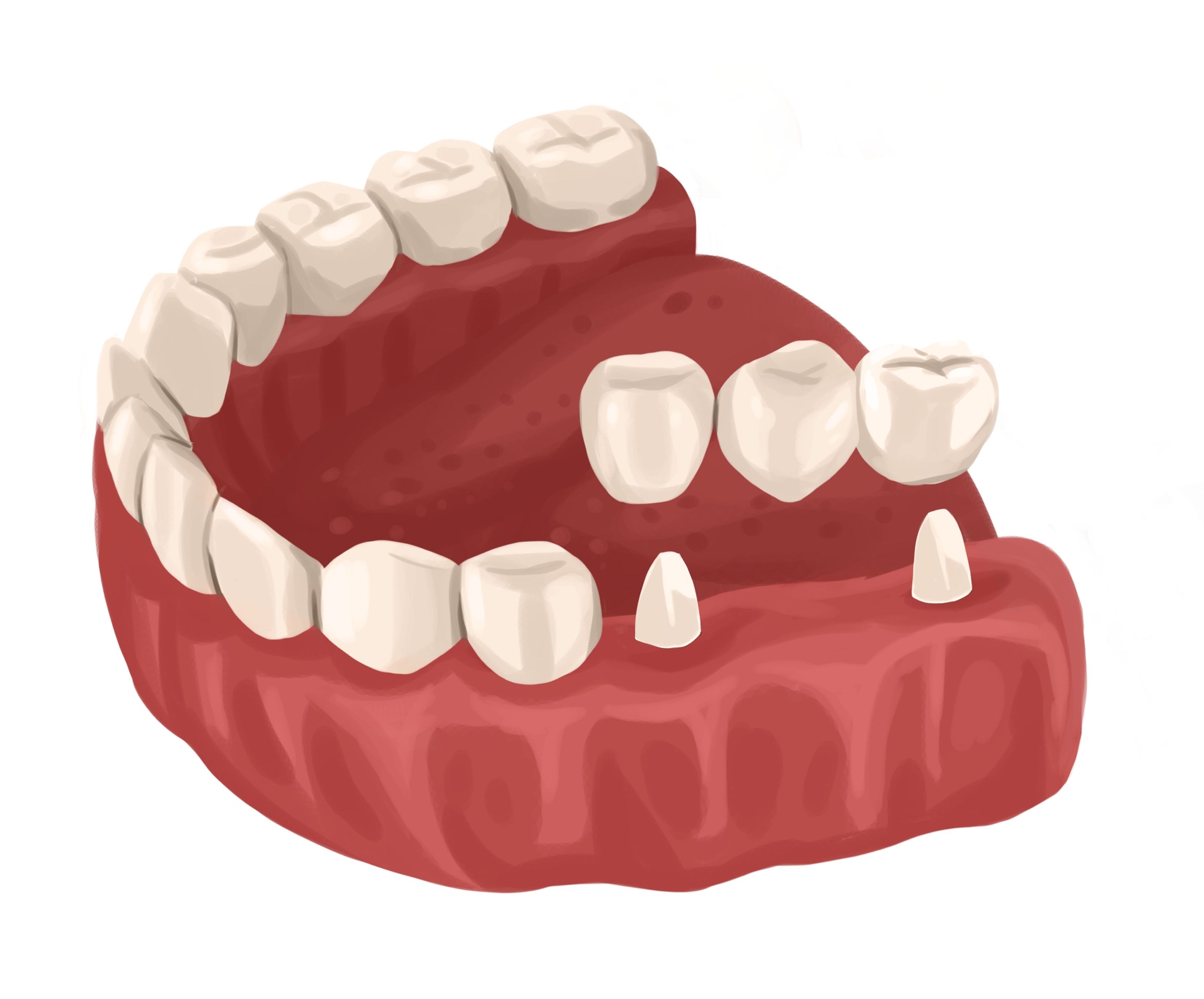 Dental bridge costs from 700 up to 2,100 Authority Dental