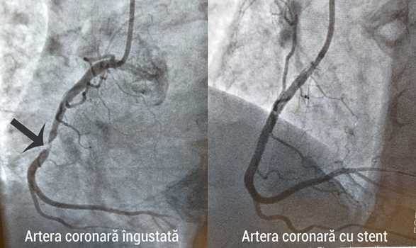 Angioplastia - când este recomandată?