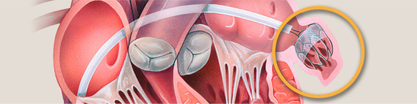 Procedura Watchman pentru Fibrilatie Atriala | Centrele Ares | Inovatie in Cardiologie