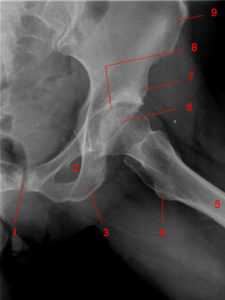 radiographie hanche profil 225x300