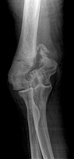 Elbow-Pre.jpg