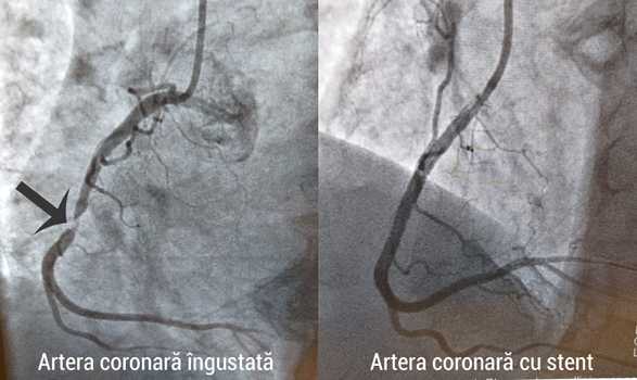 Angioplastia - când este recomandată?