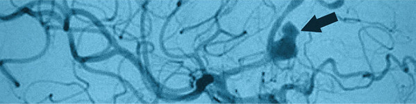 Interventie pentru anevrism cerebral | Centrele Ares | Neuroradiologie Interventionala