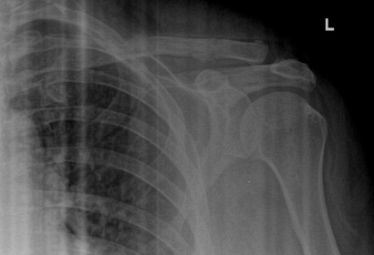 Distal_Clavicle_Repair_with_Tensioned_Cerclage_Repair_with_Bone_Tunnels.JPG