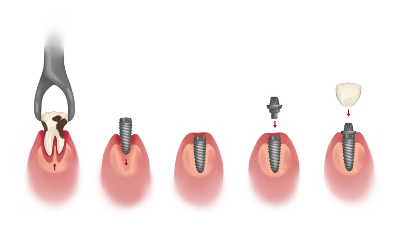 Dental implant process steps