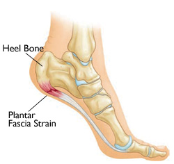 "Plantar
