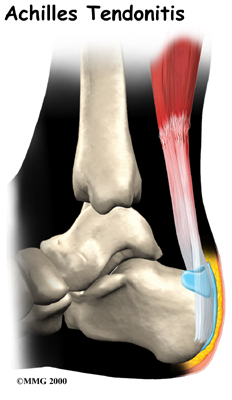 "Plantar