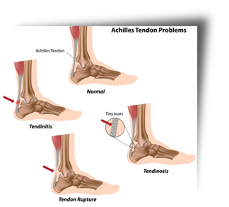 "Plantar