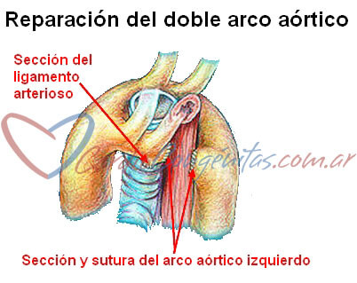 reparacion-del-doble-arco-aortico